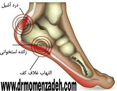 "عوامل مستعد کننده درد پاشنه"