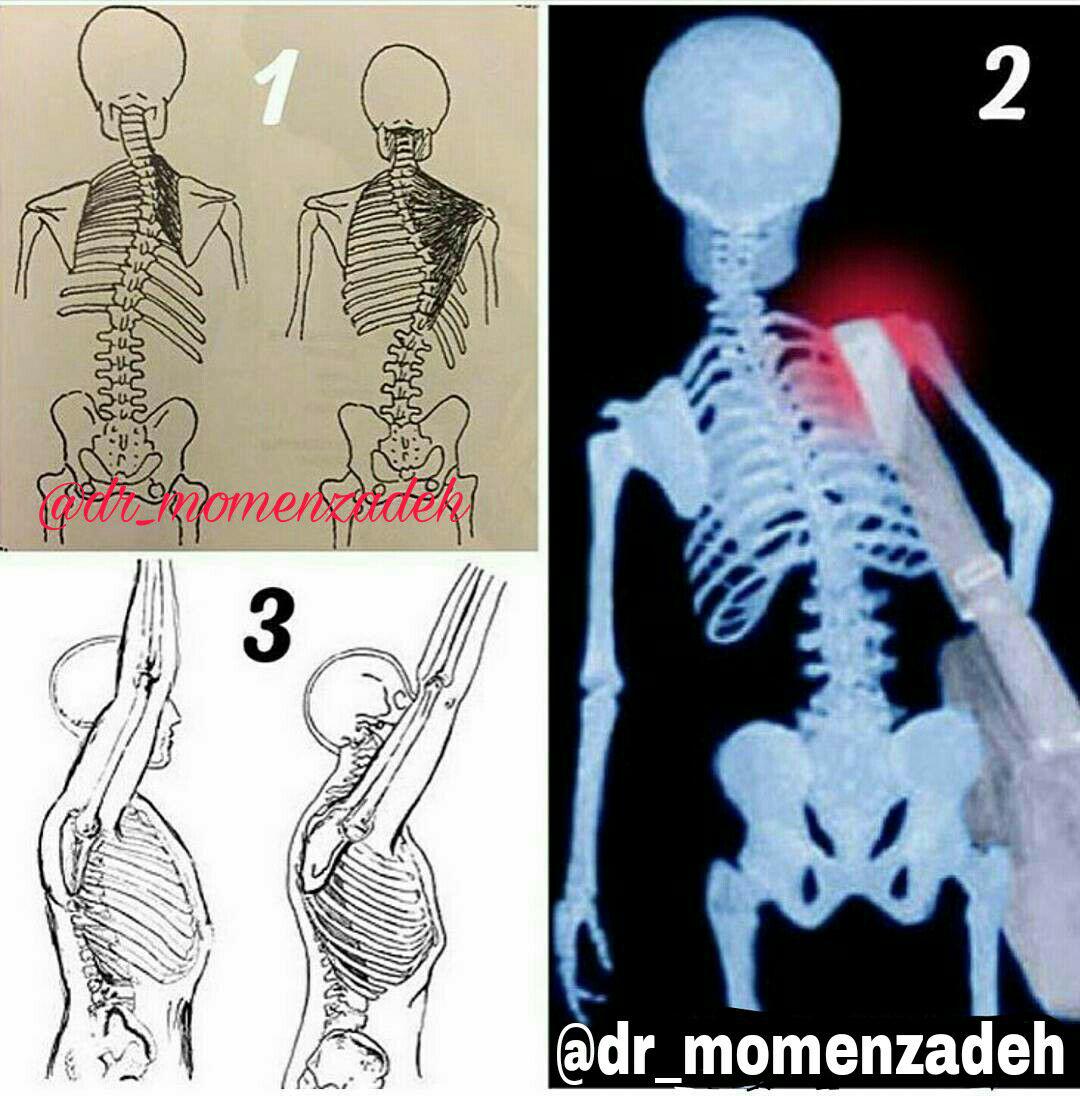 آسیب جدی کیف سنگین و کوله به شانه