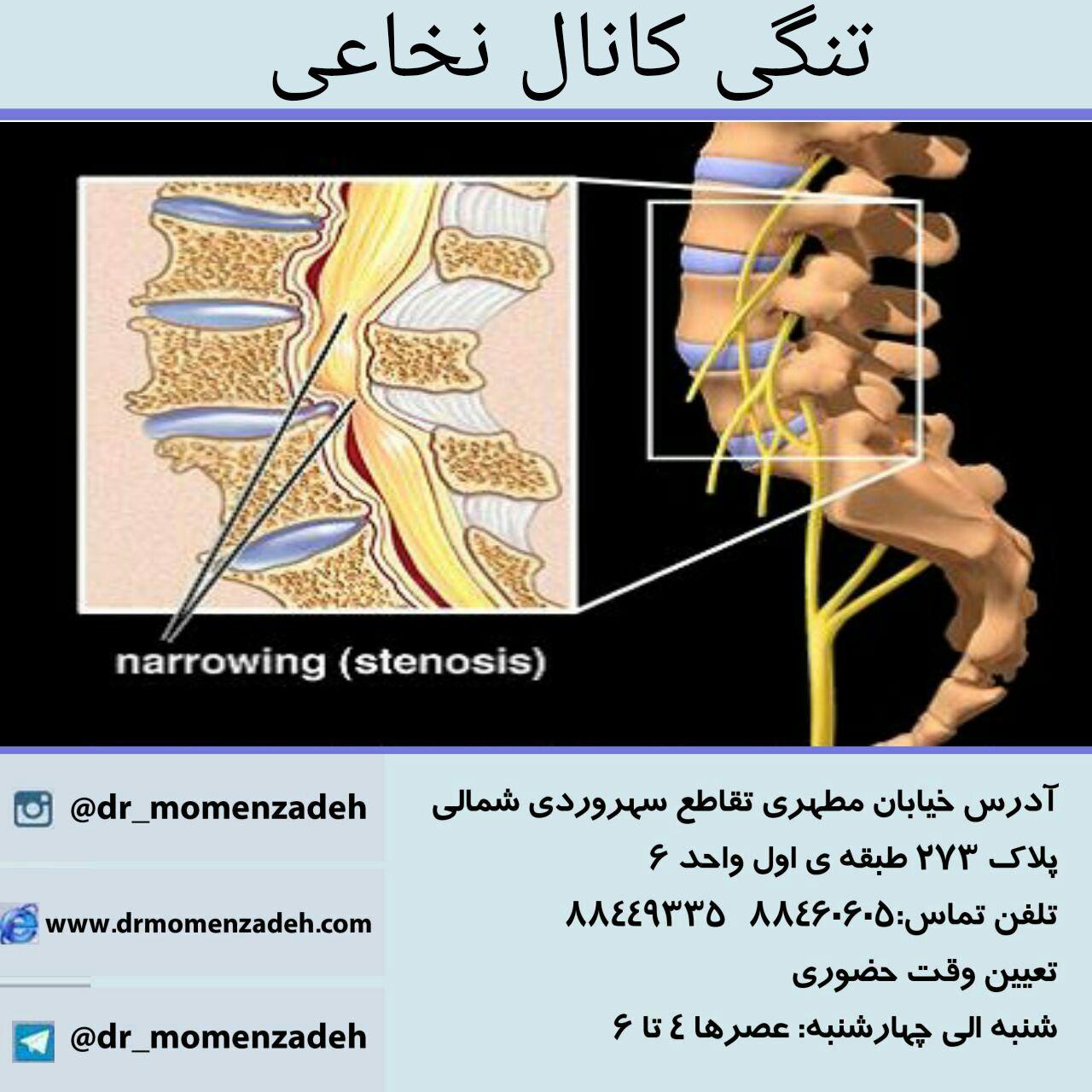 نگی کانال نخاع