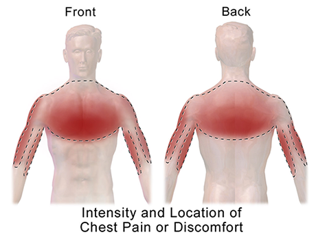 درد سینه و بازو ناشی از تندنیتیس پکتورالیس ماژور و روش های مختلف درمان