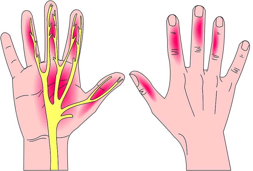 درد آرتریت مفصل انگشتان و کف دست و روش های مختلف درمان