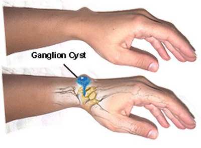درد مچ دست ناشی از کیست گنگلیونی و روش های مختلف درمان