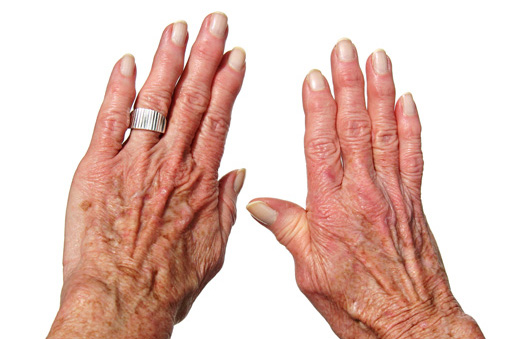 درد انگشتان ناشی از آرتریت مفاصل بین بندی انگشتان و روش های مختلف درمان