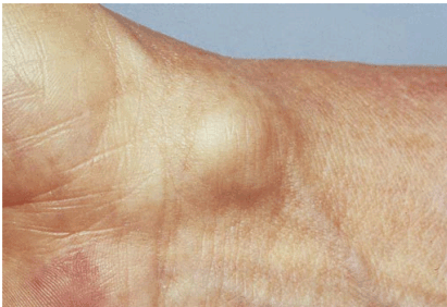 درد مچ دست ناشی از کیست گانگلیونی و روش های مختلف درمان
