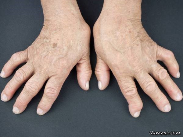 درد انگشتان دست ناشی از اختلال عصب دیجیتال و روش های مختلف درمان