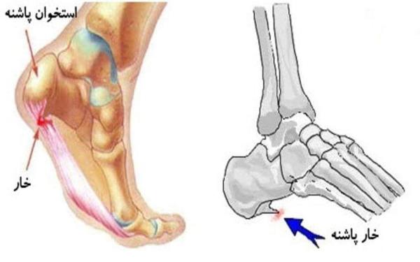  آناتومی خار پاشنه