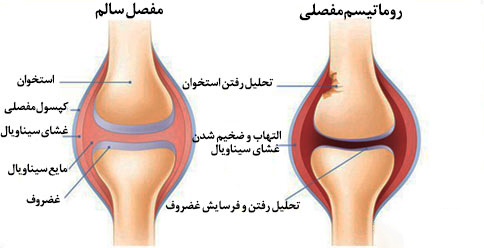 درد روماتیسم