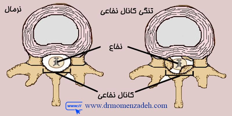 اوزون درمانی جهت درمان درد تنگی کانال نخاعی