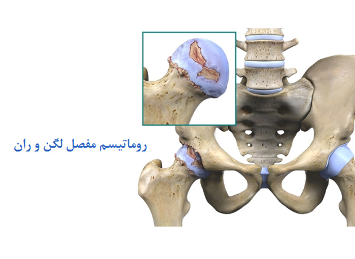 درمان درد روماتیسم لگن و مفصل ران