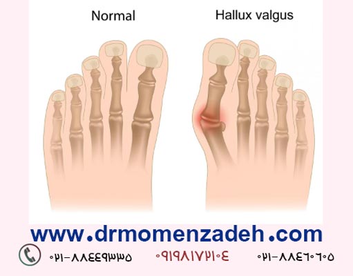 هالوکس والگوس یا خمیدگی انگشت شست پا
