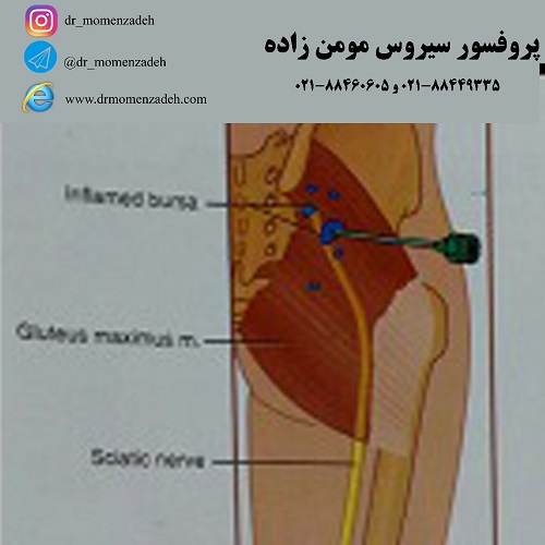 درمان درد پشت باسن با استفاده از تزریق بورس ایسکیال (Ischial)