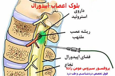 بلوک اعصاب اپیدورال 