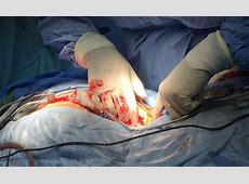 تفاوت تزریق دیسکوژل با عمل باز در درمان درد دیسک کمر