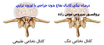 درمان تنگی کانال نخاع بدون جراحی با اوزون تراپی