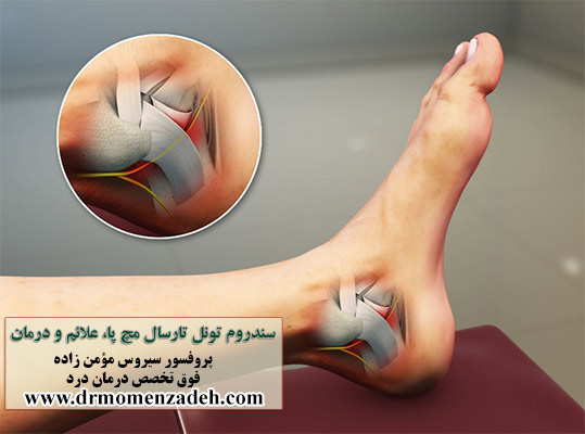 سندروم تونل تارسال مچ پا، علائم و درمان درد آن