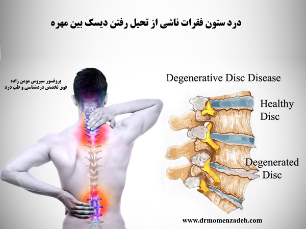 درد ستون فقرات ناشی از تحیل رفتن دیسک بین مهره ای