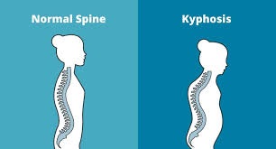 درد ستون فقرات در اثر کیفوز یا گرد بودن ستون فقرات,کیفوز چیست,کیفوز ستون فقرات,کیفوز توراسیک,کیفوز و