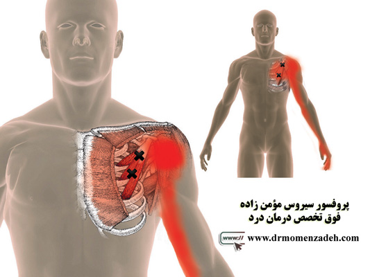 درد راجعه یا درد ارجاعی بدن