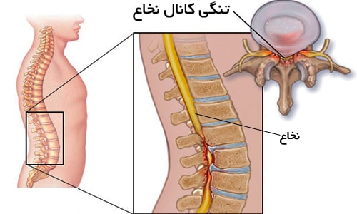 درمان درد تنگی کانال نخاع کمر