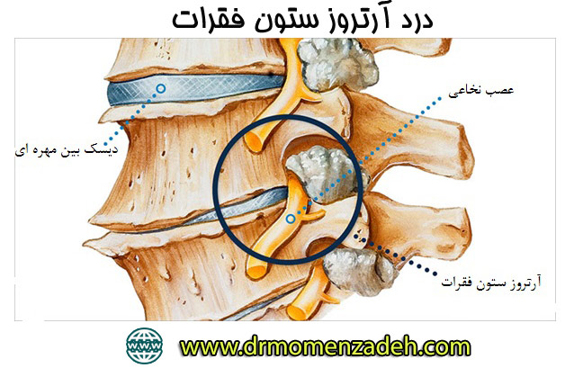 درد آرتروز ستون فقرات