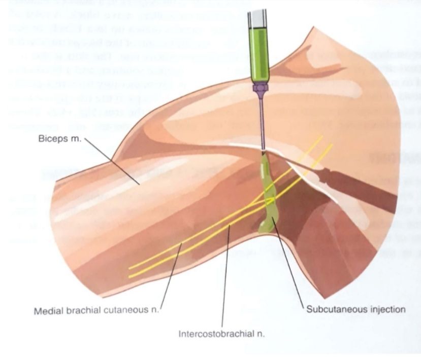 بلاک عصب مدین کوتانوس (Median cutaneous) و اینترکوستوبراکیال (Intercostobrachial), عصب مدین کوتانوس