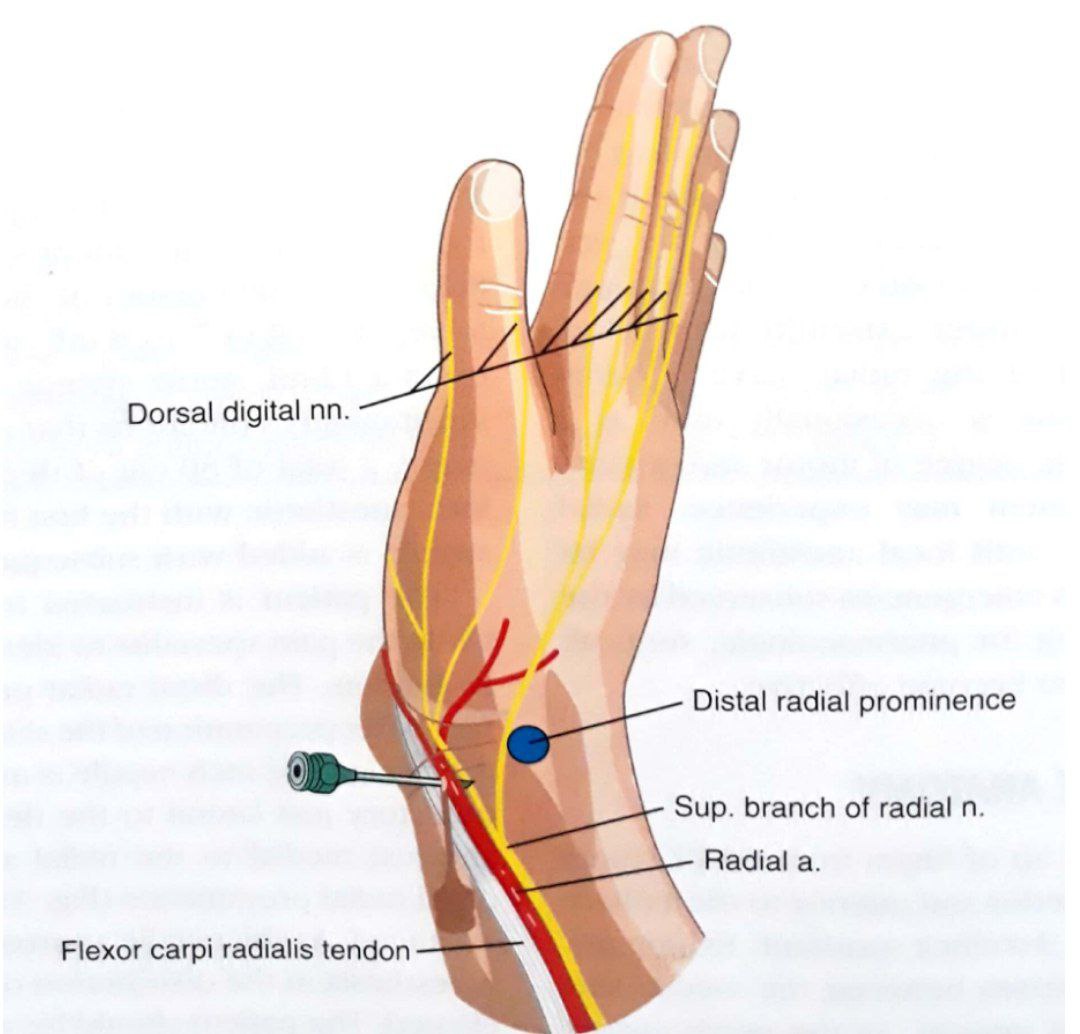 عصب رادیال مچ دست