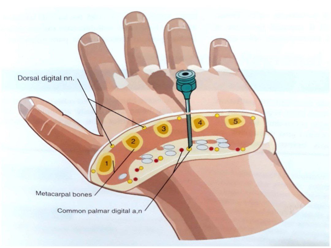 اعصاب دیجیتال و متاکارپال