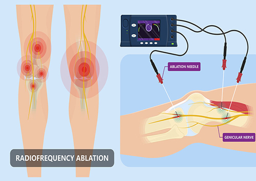 رادیو فرکوئنسی (rf) برای درمان دردهای آرتروز