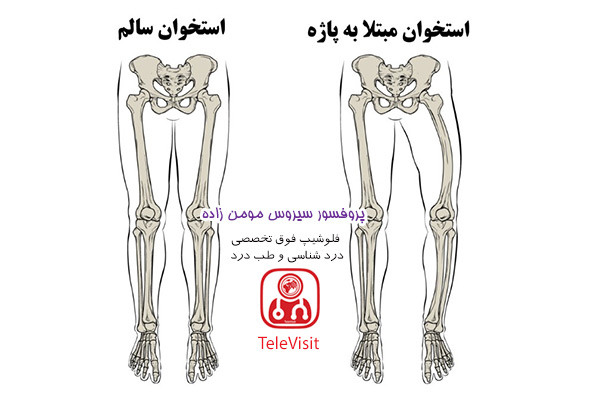 علل و علایم بیماری پاژه استخوان