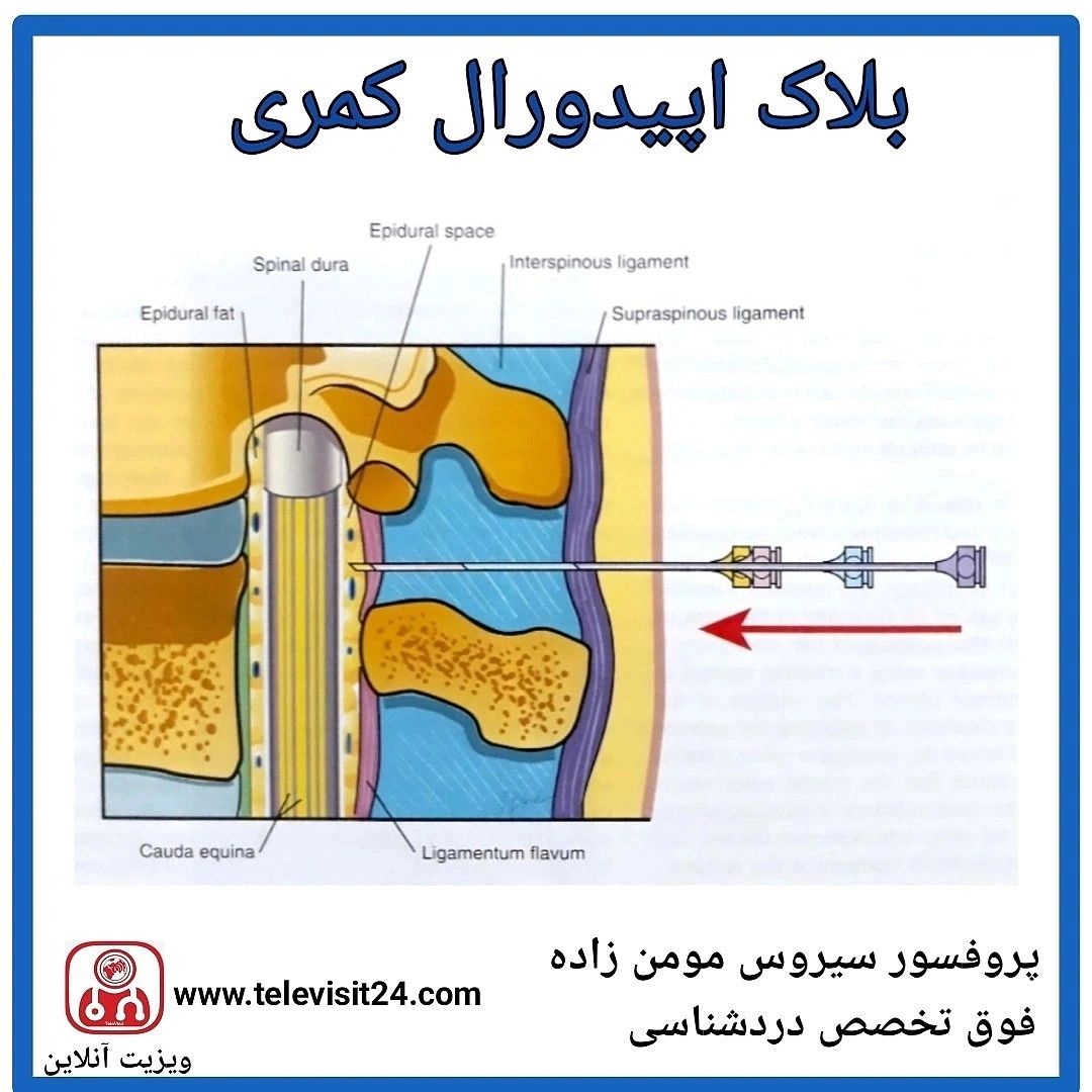 بلاک اپیدورال کمری