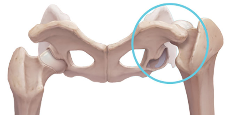علل و درمان درد ناحیه اوستئوپروز هیپ