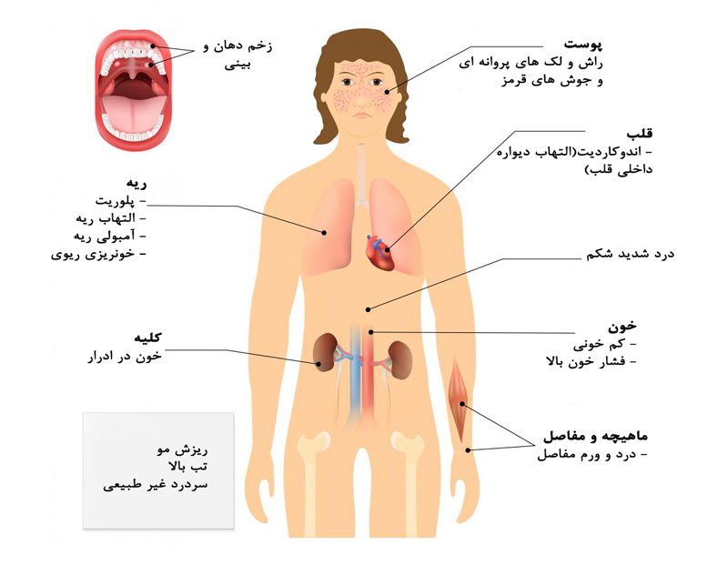 علل و علائم لوپوس 