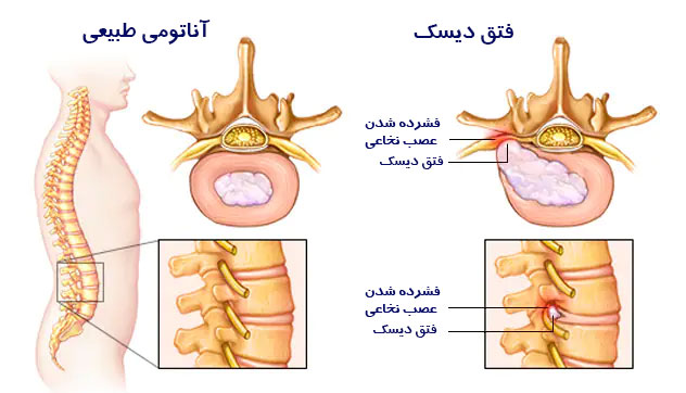 تشخیص و درمان درد فتق دیسک