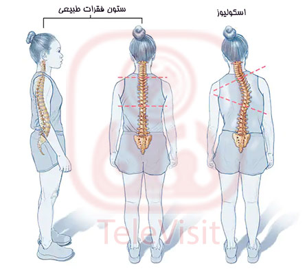 اسکولیوز، انحنای جانبی ستون فقرات