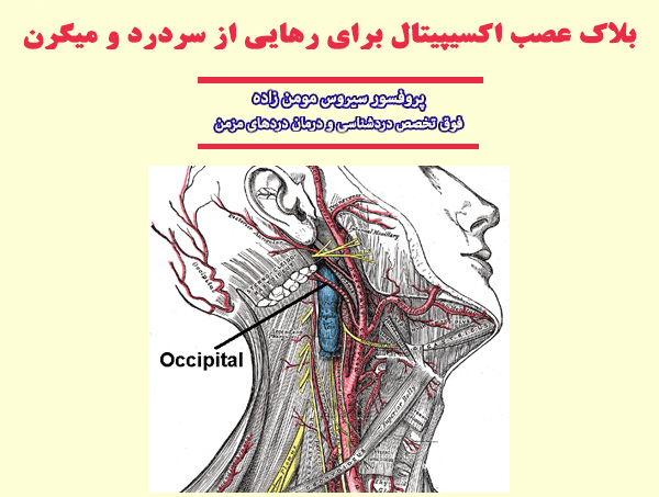 بلاک عصب اکسیپیتال برای رهایی از سردرد و میگرن