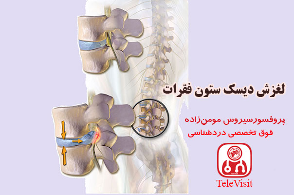 لغزش دیسک ستون فقرات