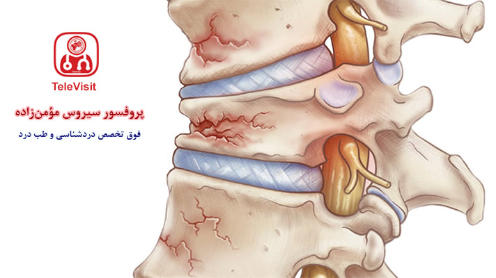 درد و شکستگی فشاری ستون فقرات