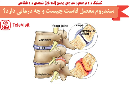 سندروم فاست چیست و چه درمانی دارد؟