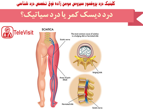 درد دیسک کمر یا درد سیاتیک