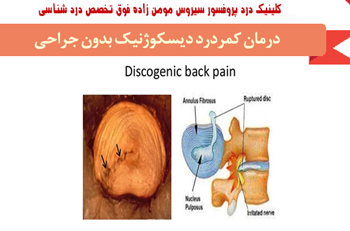 درمان کمردرد دیسکوژنیک بدون جراحی