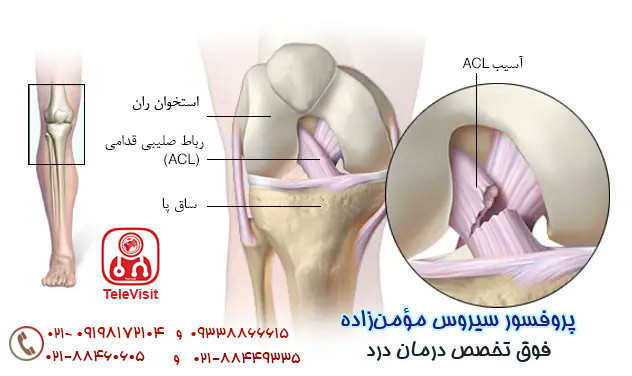 علل درد زانو،زانو درد،آسیب ACL،استخوان های زانو،منیسک پاره شده،منیسک غضروف،تاندونیت کشکک،بورسیت زانو