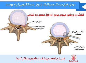 درمان فتق دیسک و سیاتیک با روش دیسککتومی از راه پوست