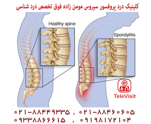 درمان اسپوندیلوز یا درد گردن و کمر به دلیل ساییدگی یا افزایش سن