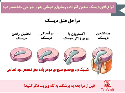 انواع فتق دیسک ستون فقرات و روشهای درمانی متخصص درد