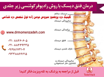 درمان فتق دیسک با روش رادیوفرکوئنسی زیر جلدی