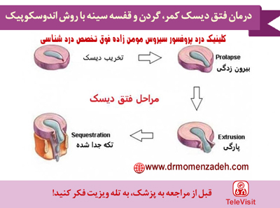 درمان فتق دیسک کمر، گردن و قفسه سینه با روش اندوسکوپیک 