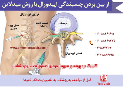 از بین بردن چسبندگی اپیدورال با روش میدلاین 