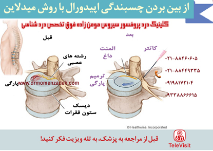 درمان فتق دیسک با روش الکتروترمال (Intradiscal Electrothermal)