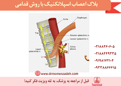 بلاک اعصاب اسپلانکنیک با روش قدامی