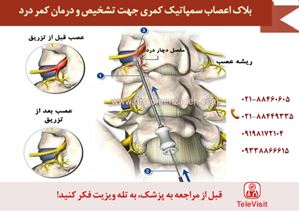 بلاک اعصاب سمپاتیک کمری جهت تشخیص علت و درمان کمر درد